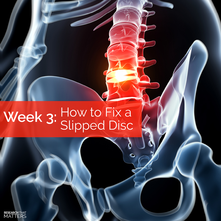Chiropractic-Care-For-Slipped-Disc-in-Coral-Springs-FL Chiropractic Care For Slipped Disc in Coral Springs FL