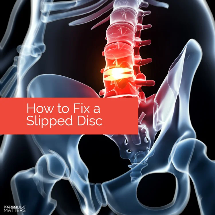 How To Fix A Slipped Disc in Coral Springs FL