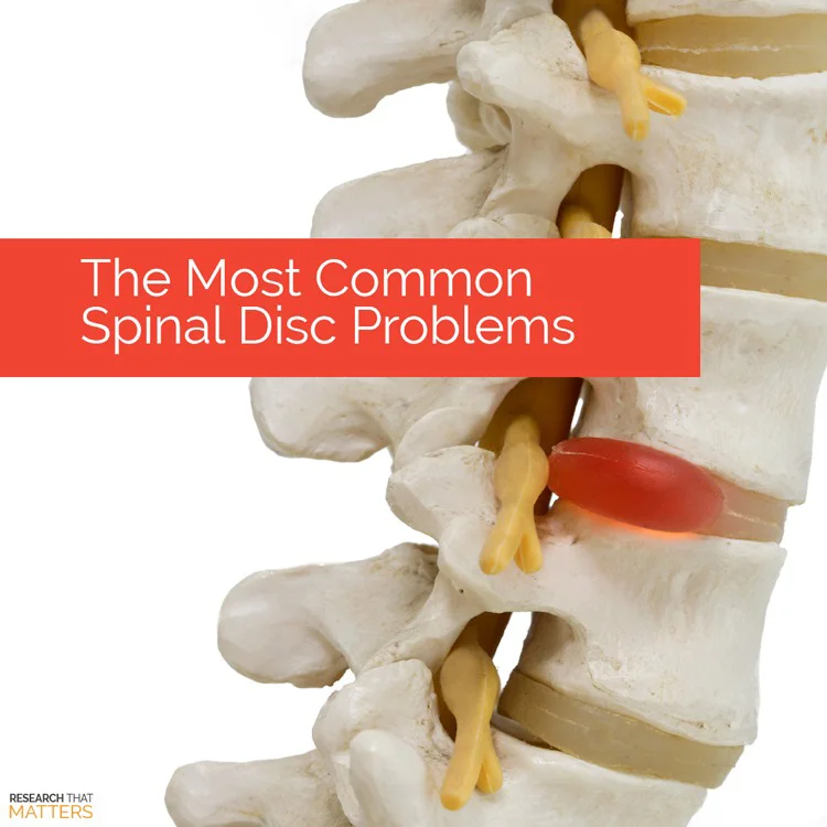 The Most Common Spinal Disc Problems
