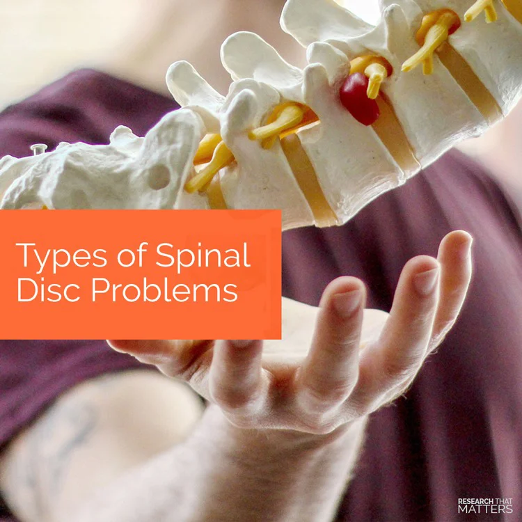 Types Of Spinal Disc Problems In Coral Springs FL